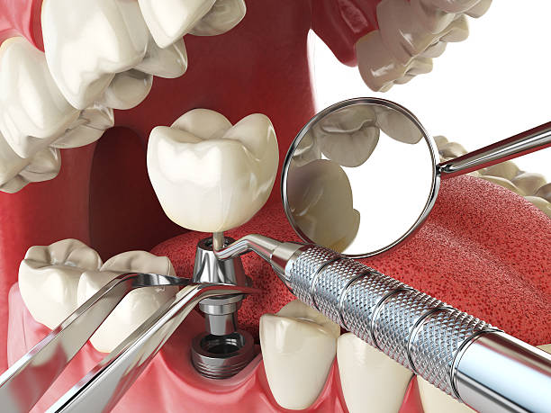 Best Emergency Root Canal Therapy in North Utica, IL